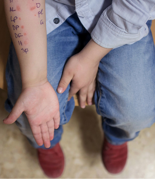 Kids arm with allergy test marks on it