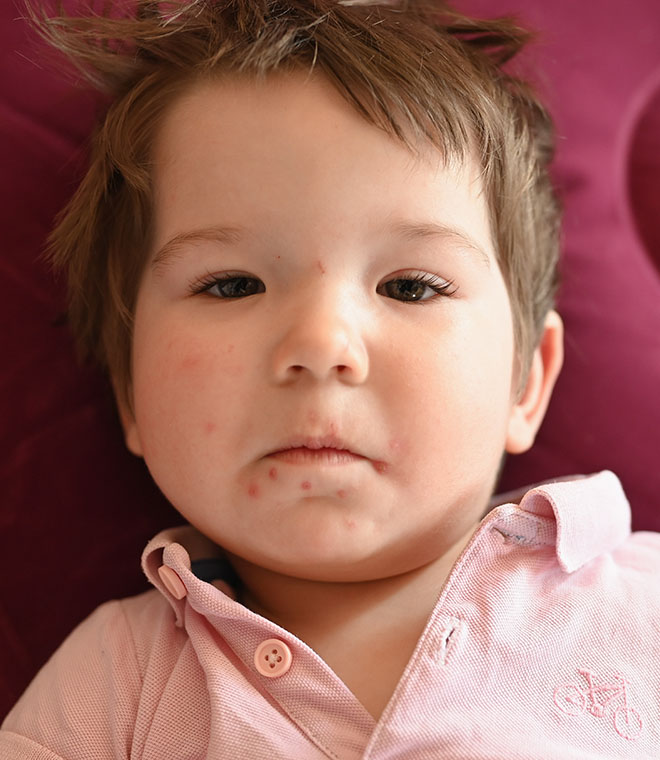 Baby girl with spots around her mouth