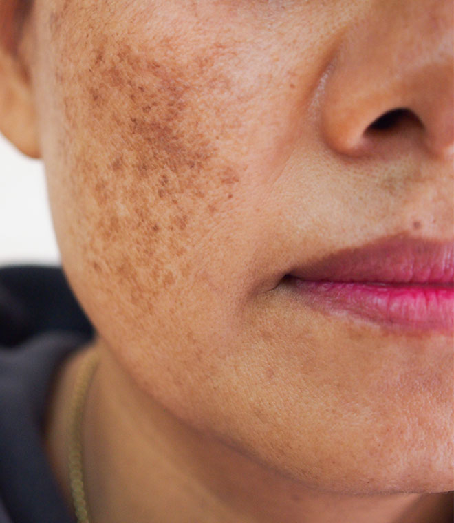 Dark spots on a womans cheek